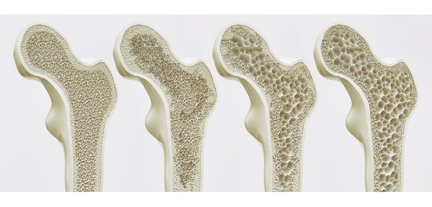 Osteoporosis 4 Stages - 3D Rendering